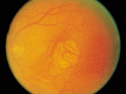 age related macular disease