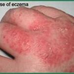 eczema