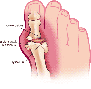 knee gout pictures